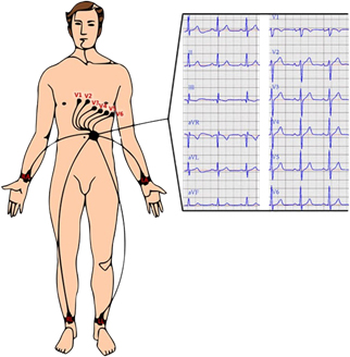 ekg